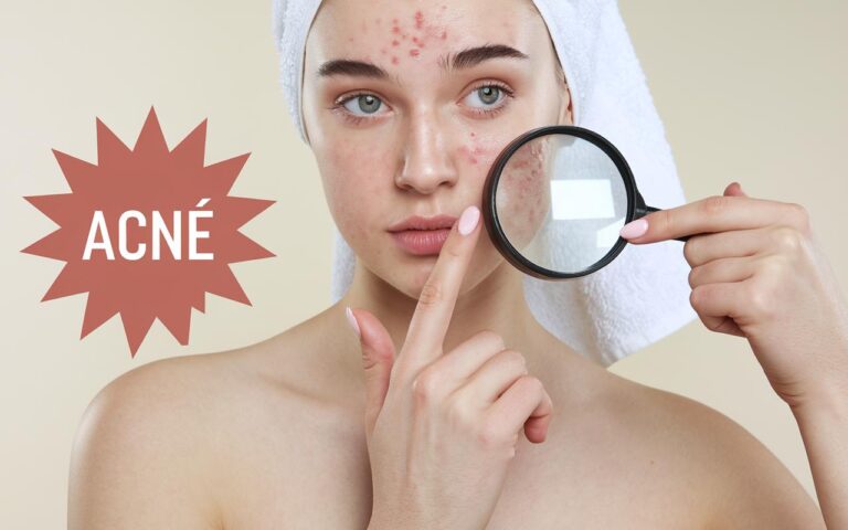 Consigli di bellezza / Combattere l’acne